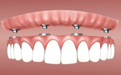 ¿Qué debo hacer después de colocarme implantes dentales?