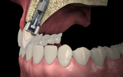 ¿Qué tan duraderos son los implantes dentales?