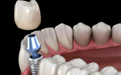 ¿Cómo puede ayudarme un implante dental?