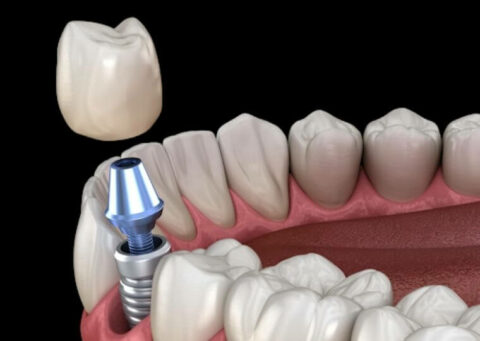 ¿Cómo Puede Ayudarme Un Implante Dental? - Dentista Las Arenas