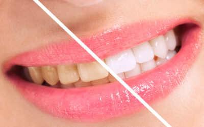 Las manchas dentales más frecuentes:  causas y soluciones