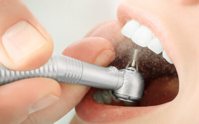 ¿Es dolorosa la limpieza dental?