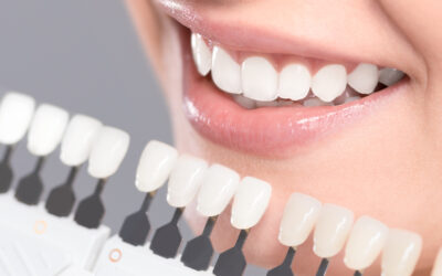 Así se realiza un blanqueamiento dental