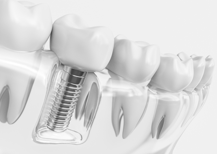 ¿Cómo saber si necesito un implante dental?
