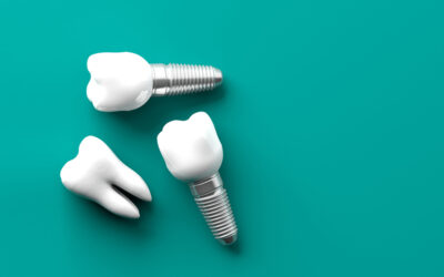 Cuidados para mantener en perfecto estado tu implante dental