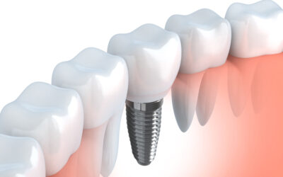 Razones para necesitar  un implante dental