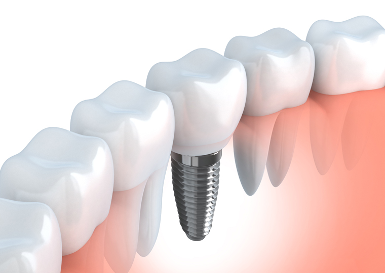 Razones para necesitar  un implante dental