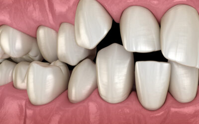 Malposición dental y maloclusión: Ventajas de tratarlas