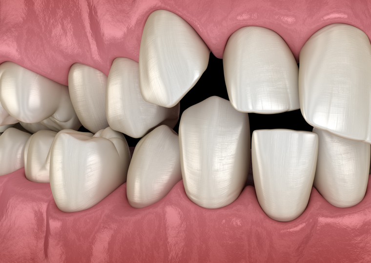 Malposición dental y maloclusión: Ventajas de tratarlas