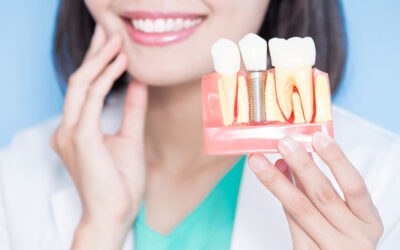 ¿Qué son los implantes de carga inmediata y los injertos de huesos?
