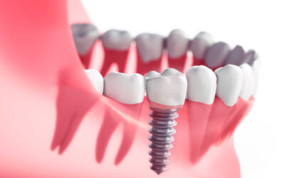 Cómo saber si necesitas un implante dental