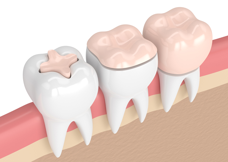 ¿Qué es la hipoplasia dental y cómo afecta la salud dental?