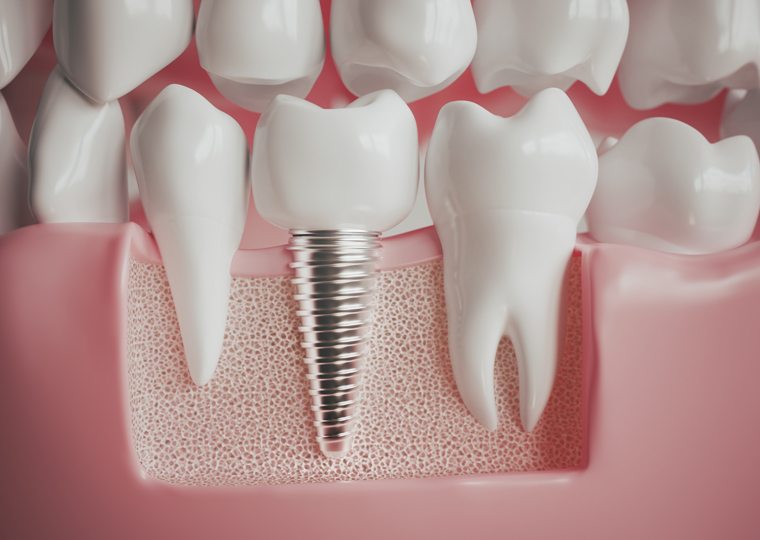 ¿Cuándo es necesario poner un implante dental?