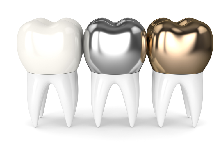 ¿Qué es una corona dental?  ¿Cuándo es recomendable?