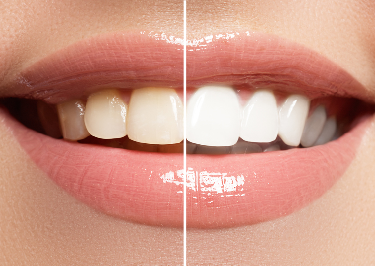 Mitos y realidades de los blanqueamientos dentales