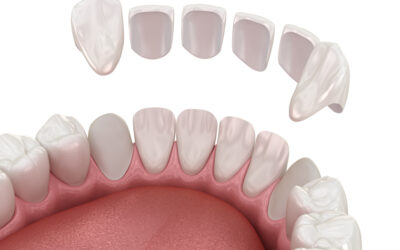Las carillas dentales…  ¿Cuándo son recomendables?