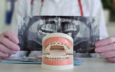 ¿Qué tipos de endodoncias existen?