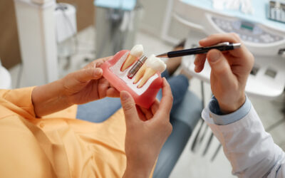 Mitos comunes sobre los implantes dentales: lo que debes saber