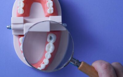 ¿Cómo reconocer las primeras señales de caries?