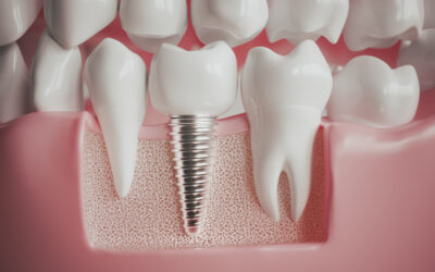 Prótesis digitales impresas en 3D: rapidez, estética y máxima precisión