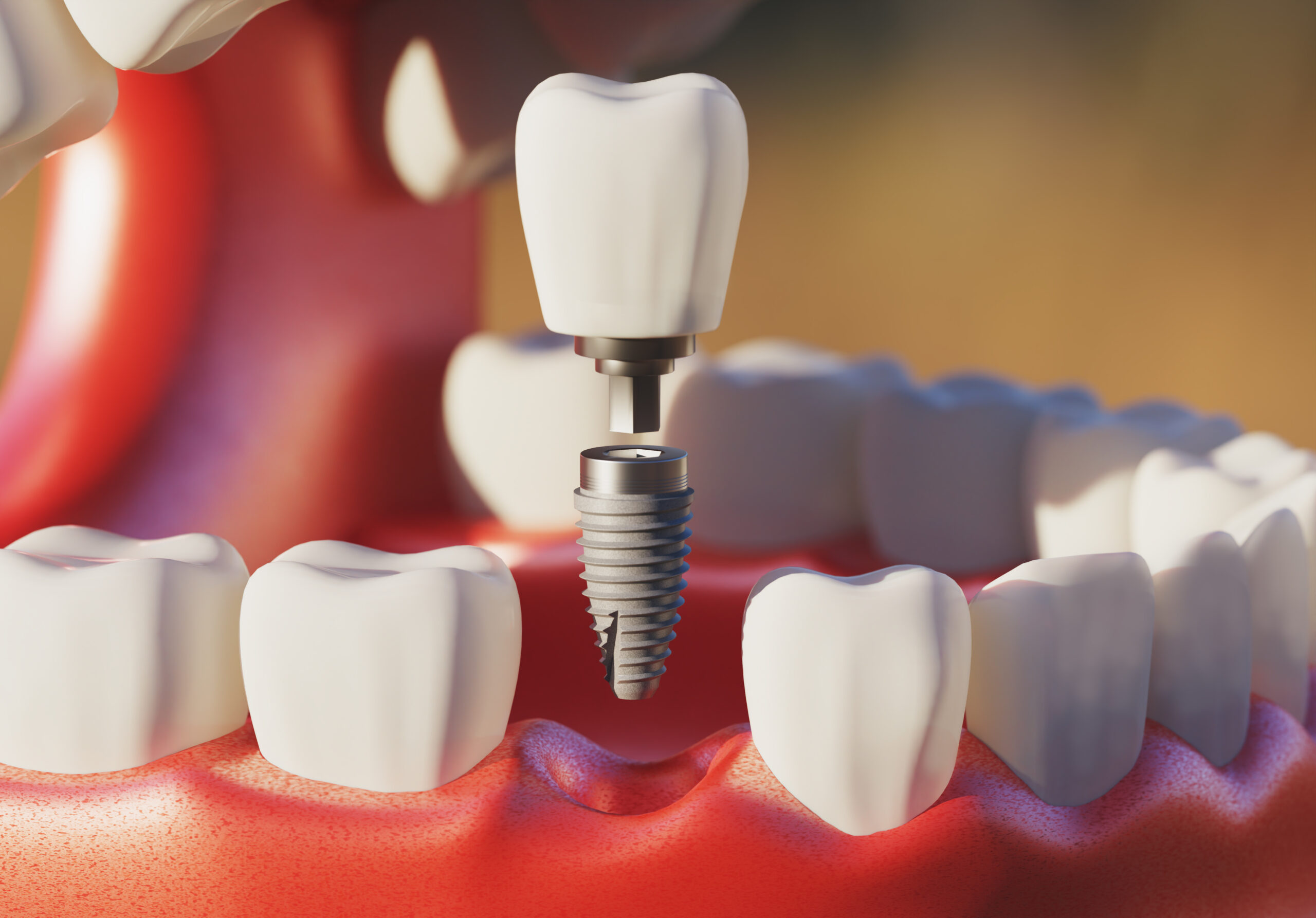 Mini-implantes: en qué casos son una alternativa real
