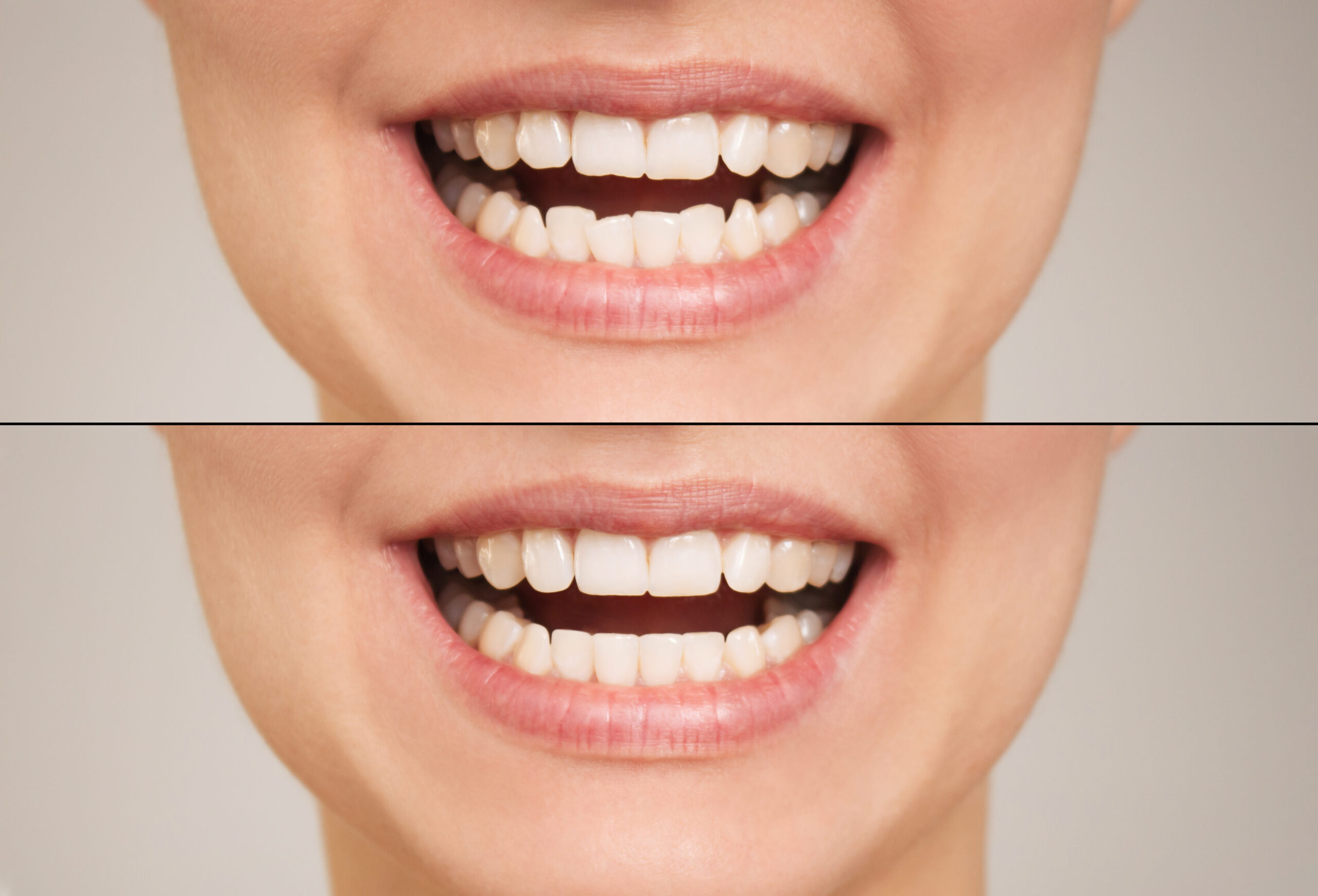 Diseño Digital de una Sonrisa 4.0: lo último en estética digital 
