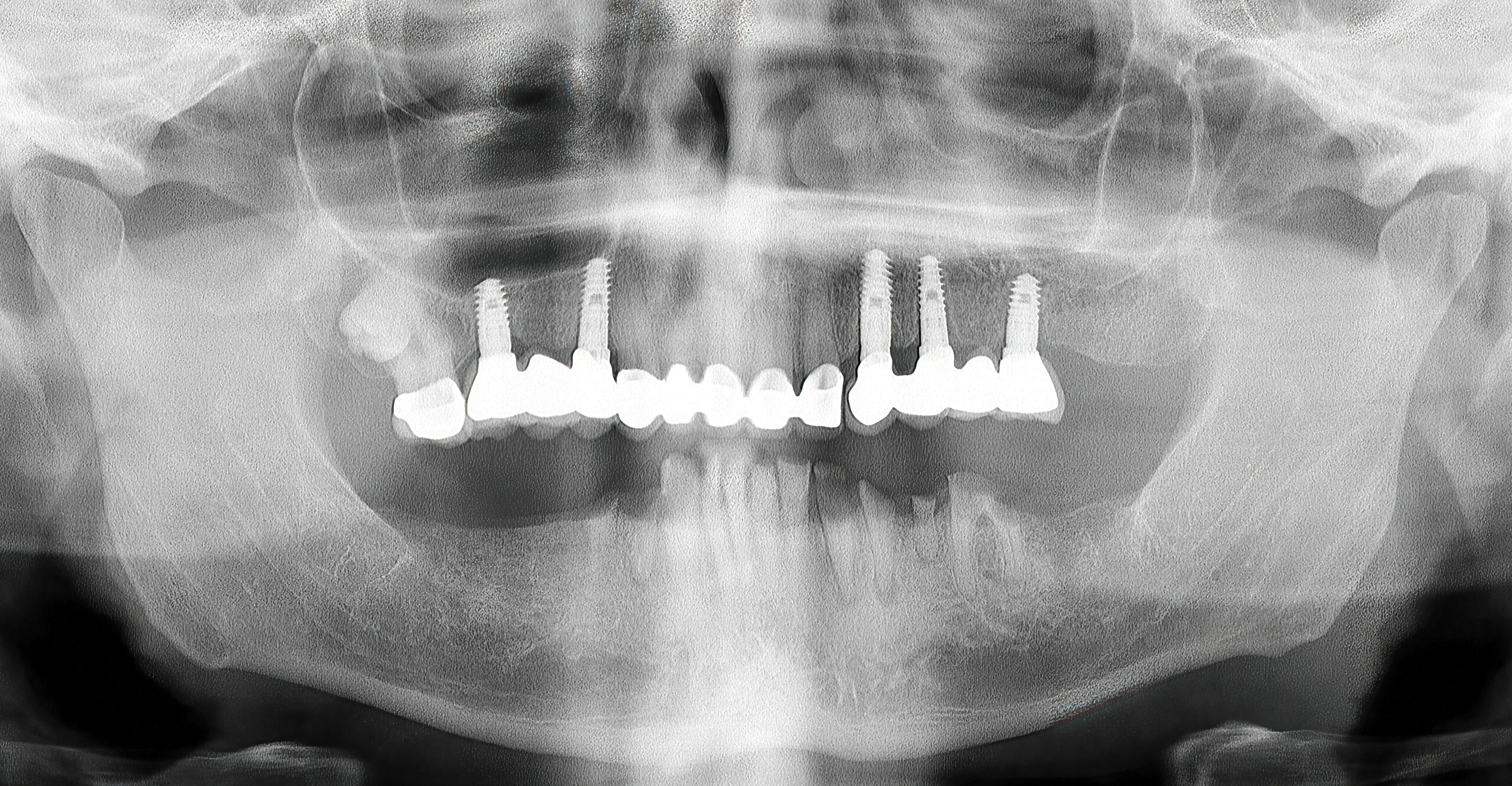 Periimplantitis: nuevas técnicas de prevención y tratamiento