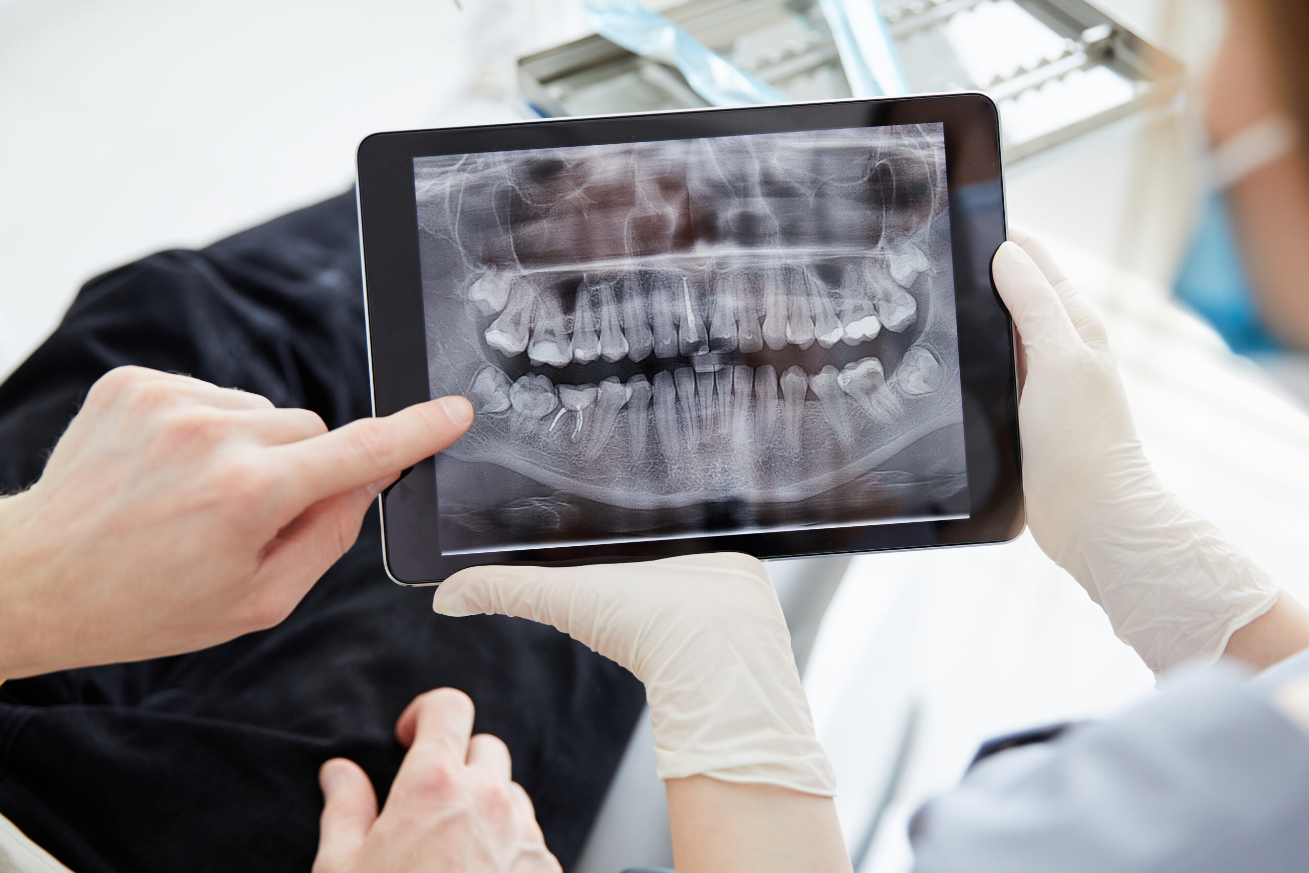 Periimplantitis: nuevas técnicas de prevención y tratamiento