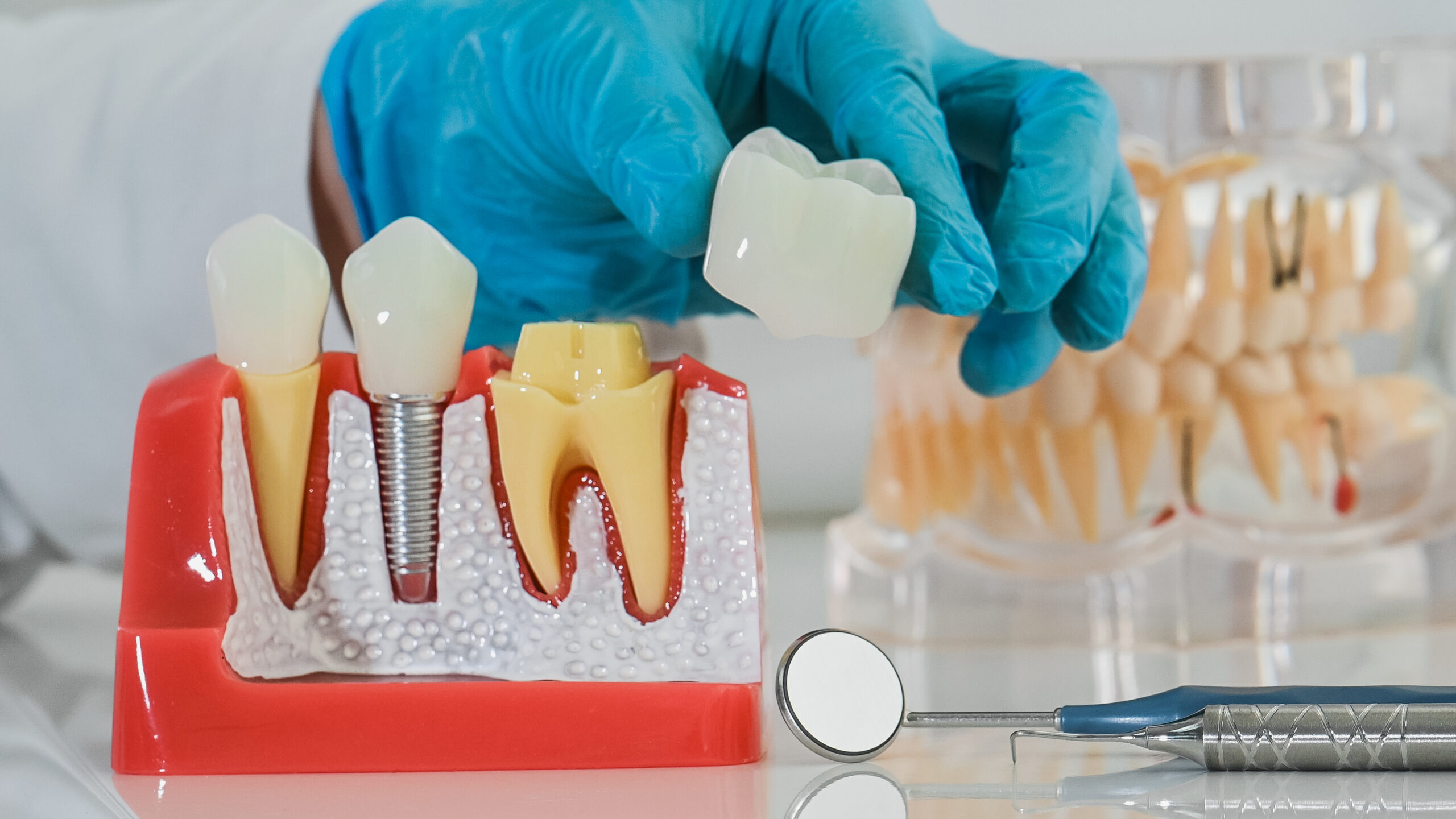 Prótesis sobre implantes: diferencias entre carga inmediata y diferida