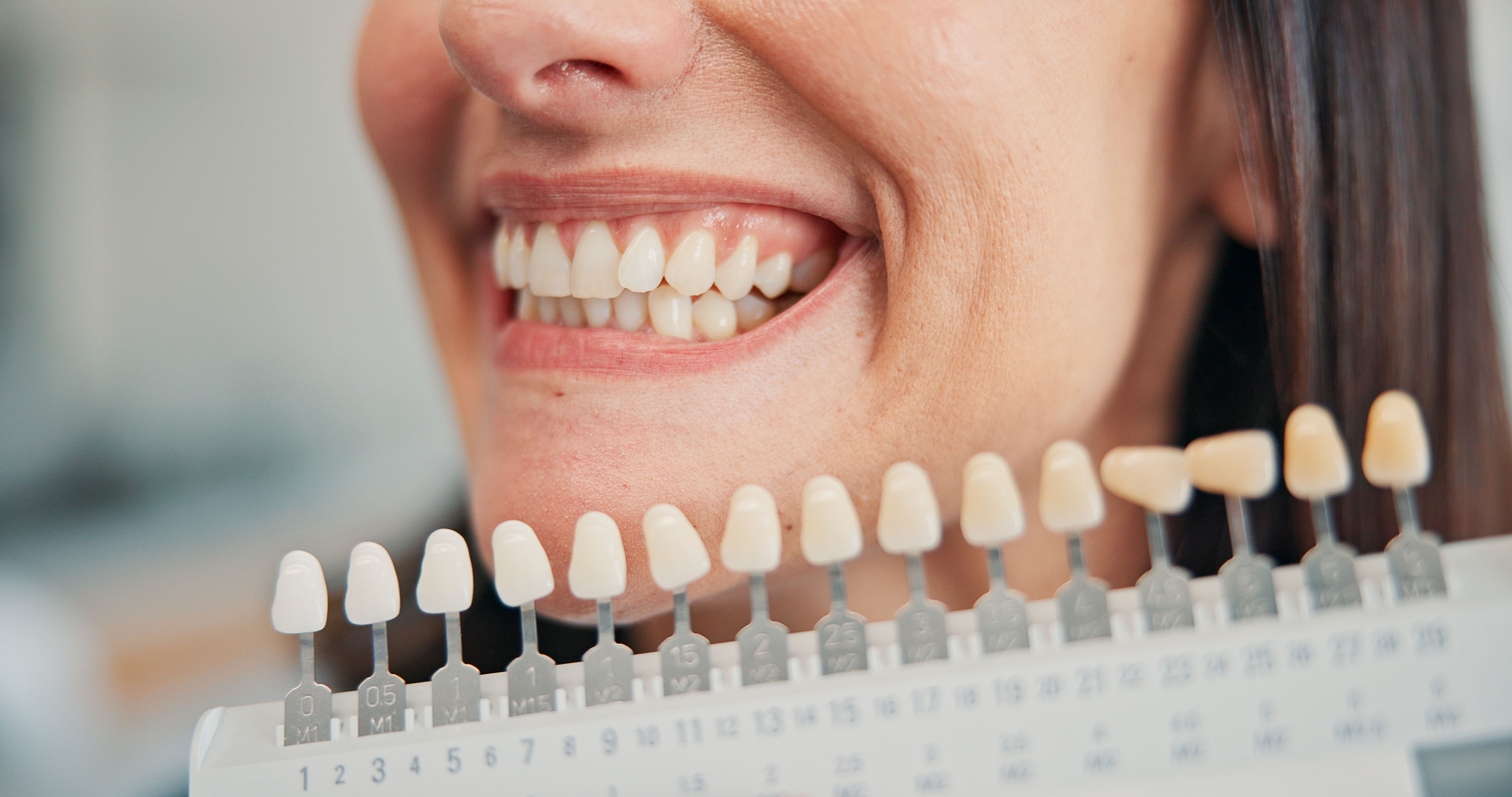 Contorneado estético de encías: 
el detalle que transforma la sonrisa
