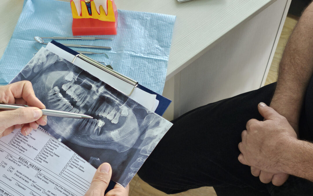 Prótesis completas vs. implantes: cómo elegir la mejor opción