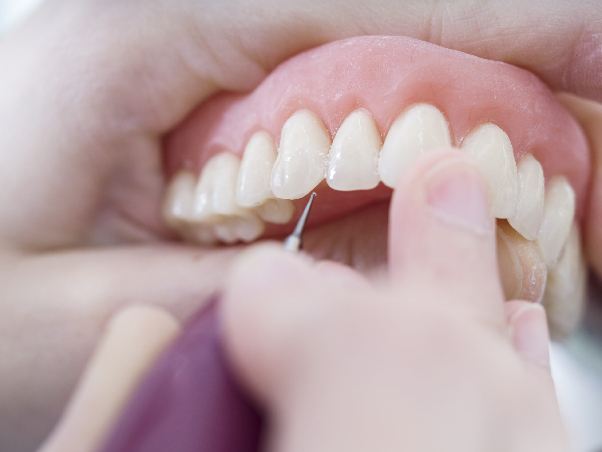Prótesis completas vs. implantes:
cómo elegir la mejor opción