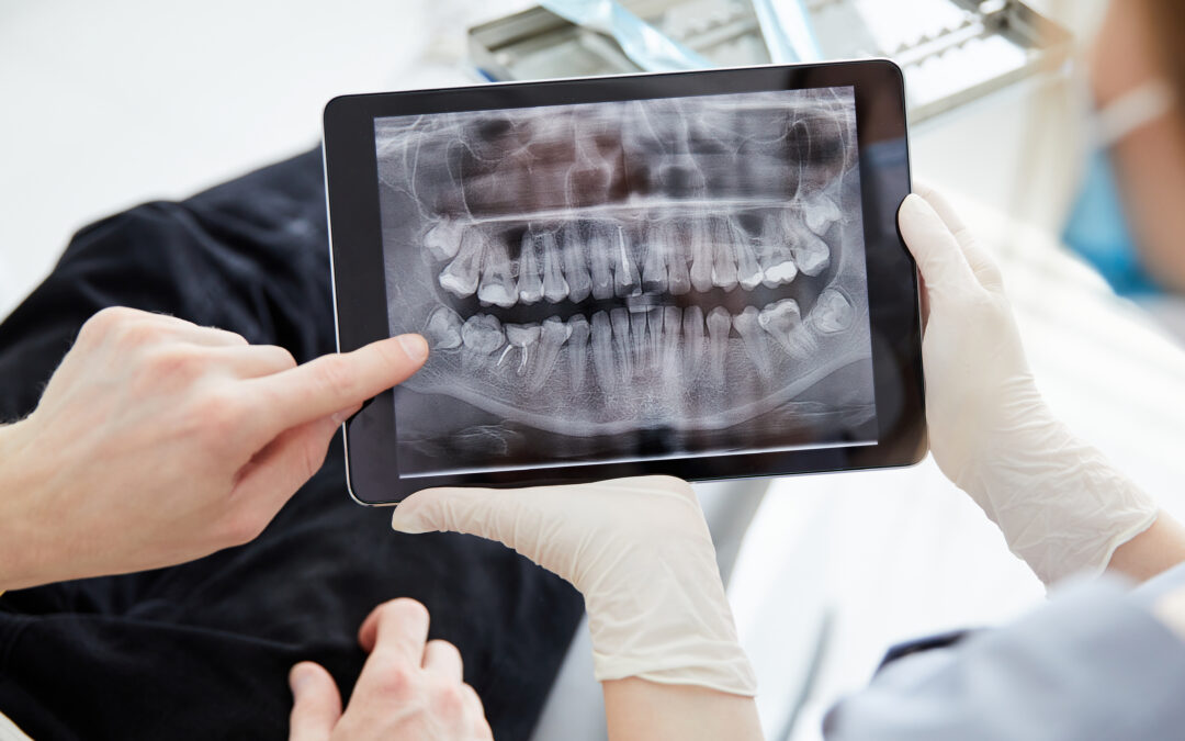 planificación de un implante dental